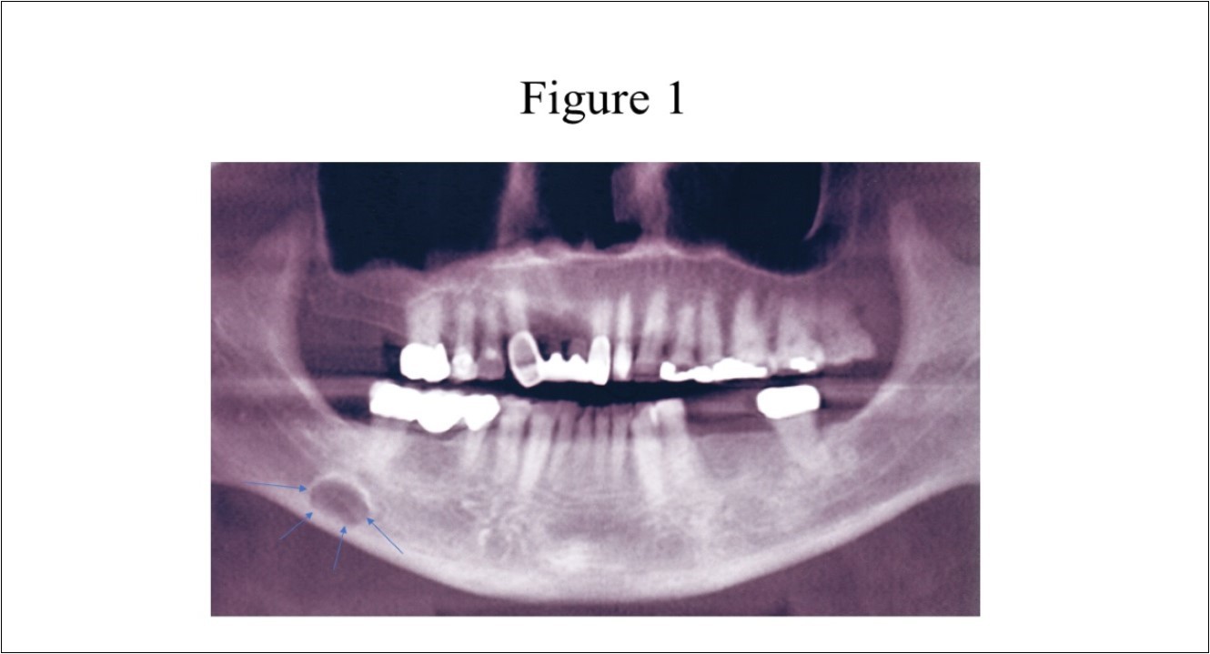 Panoramic radiograph of classically described SBC of the right posterior              mandible illustrates the well-defined unilocular radiolucency in the right posterior                mandible between the inferior alveolar canal and the inferior border of the mandible (arrows).