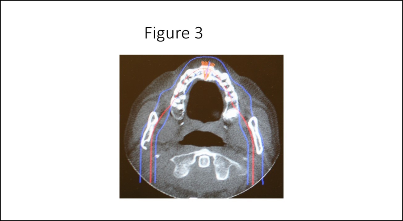 Axial cone beam CT scan showing osseous bone defect with herniation of soft tissue in the medial cortex of the right subcondylar neck of the mandible.