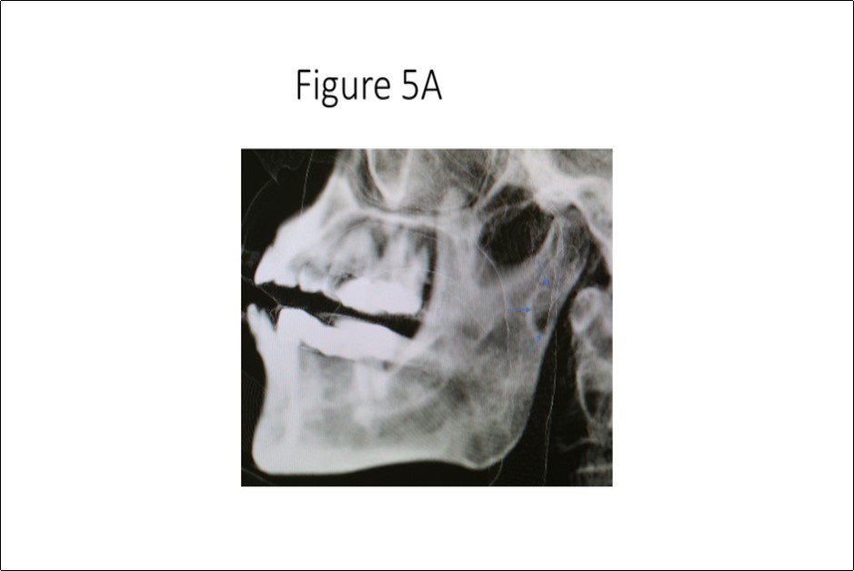 Three-dimensional cone beam CT scan reconstruction revealing               osseous defect in medial cortex of right subcondylar neck of mandible.