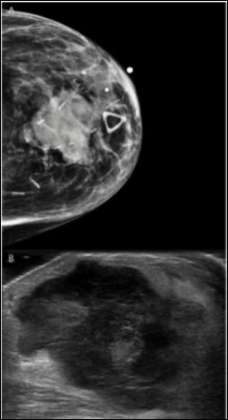 Radiological Findings. Radiographic imaging of the breast revealed a heterogeneous,                     hypoechoic solid mass with vascularity measuring 3.3 cm with associated thickening of the skin. A.     Tomography, B. Ultrasound