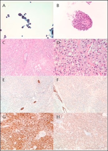 Histopathological Findings. Fine needle aspiration revealed spindled, pleomorphic cells with numerous mitoses and apoptotic        bodies. The cells were negative for cytokeratins and markers of breast, gastrointestinal, and hepatobiliary differentiation. Microscopic                    examination of the resected tumor revealed a poorly differentiated      neoplasm with predominantly spindled morphology and diffuse                expression of markers of melanocytic differentiation. A. Thinprep (40x), B. Cell block (H&E, 20x), C. H&E (10x), D. H&E (40x), E.                Pan-cytokeratin (10x), F. GATA3 (10x), G. S100 (10x), H. SOX 10 (10x).