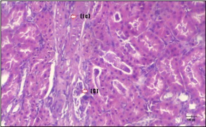 Photomicrogragh of kidney section of diabetic rat showing a trophy of Bowman,s  capsules and damage of glomeruli  (arrow) and damage of distal and proximal tubules with congested blood vessels (star) . (H&E) (100Px).
