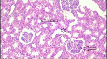 Photomicrogragh of kidney section of treated rat with both Fenugreek and Glimepiride showing improved cortical tissue with most of both Bowman,s capsules  (arrow) and proximal tubules (dash-arrow) with nearly normal structure .Note distal tubules still suffering (star). (H&E) (40X).