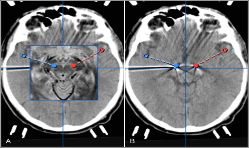 Pre- and postoperative computertomography merge showing tips of electrodes fused to bilateral trajectories of planned STNDBS