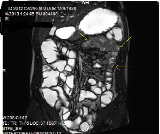 Diffuse mucosal involvement and increased wall thickness with loss of  valvula conniventes in the ileal segments on T2W coronal images after OCA administration, seen on 30 years old  female with moderate Crohn’s disease.