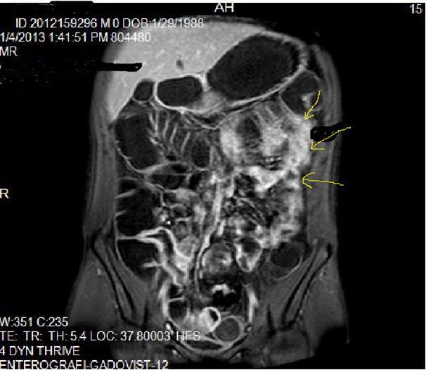 Diffuse bowel wall enhancement in the small intestine due to Crohn’s disease on the Post-contrast T1W coronal sequence.