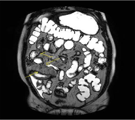Concentric luminal narrowing, mural and transmural involvement of terminal ileum due to Crohn’s disease in T2W coronal sequence after OCA application.