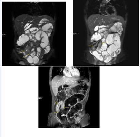 Diffuse mucosal involvement and extreme luminal narrowing in the terminal ileum due to Crohn’s disease on T2W coronal sequence after OCA administration, stricture and string sign near ileo-ceccal valve in Figure 3b.