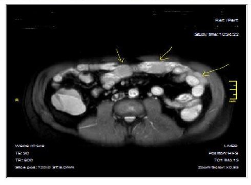 Mucosal, luminal and bowel wall involvement in Crohn’s disease with skipped lesions, seen at T2W axial image after OCA,  presented at 45 years old male with severe inflammatory disease.