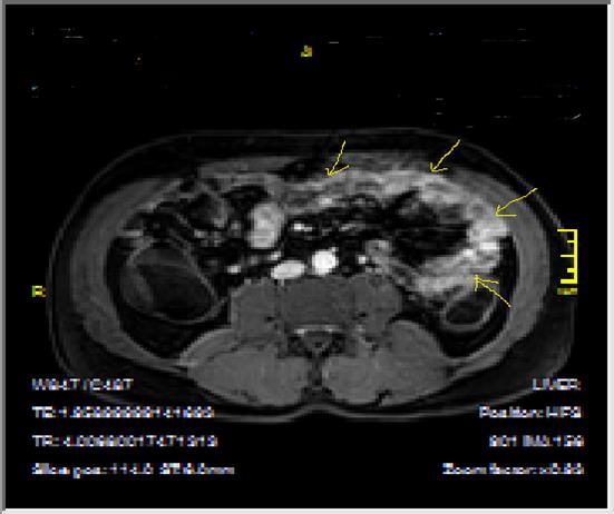 Enhancing bowel segments due to Crohn’s disease, on T1W post-contrast axial image, luminal enhancement is predominant, shown at 62 years old female with mild disease status.