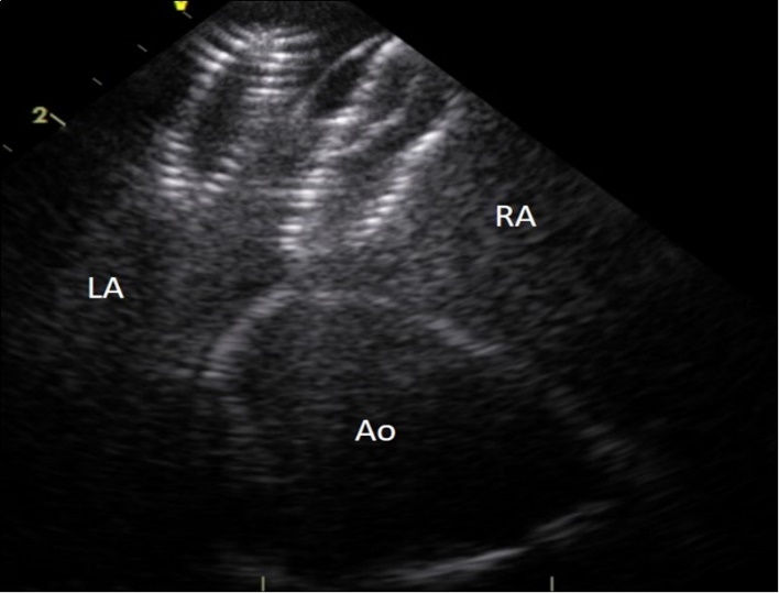 Entraped Amplatzer ASD closure device in the left ventricular outflow tract. LA : left atrium, AO : aorta, arrow : ASD closure device.