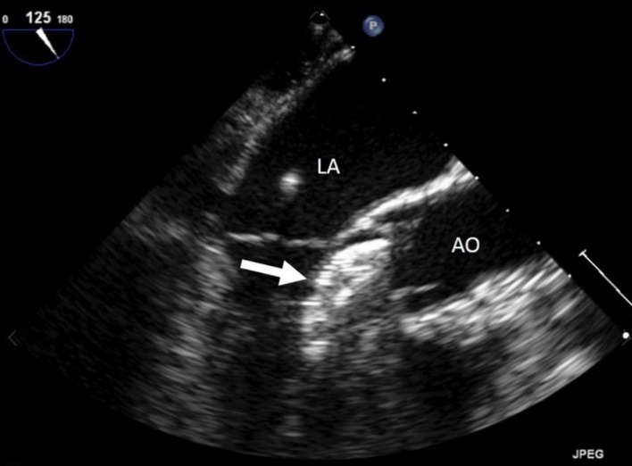 Intracardiac ultrasound picture of the ASD Amplatzer device in place on the interatrial septum. RA :right atrium. LA:left atrium. Ao :aorta
