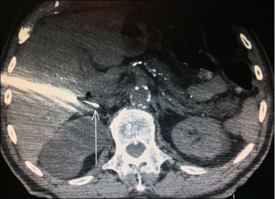 Right adrenal needle biopsy (arrow)