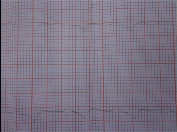Electrocardiogram: epicardial ischemia in the     infero-lateral territory.
