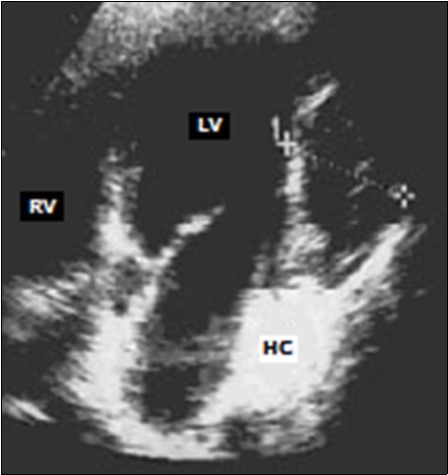 Trans-thoracic echocardiography:   echogenic, heterogeneous mass of the                       infero-posterior wall of the left ventricle (LV: left ventricle, RV: right ventricle, HC: hydatid cyst).