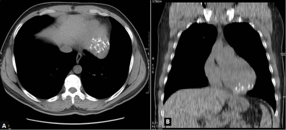 Thoracic CT without injection, mediastinal window, axial view (A) and coronal                           reconstruction (B): left ventricular mass with multiple calcifications in strata.