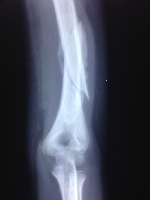 Partially united and angulated humerus shaft fracture          prior to LLLT administration in one patient