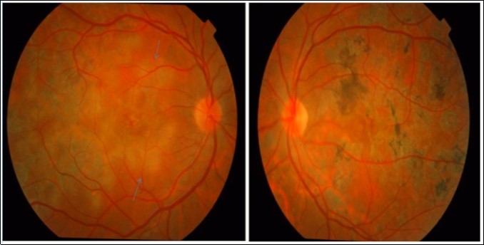 Color photograph of the right eye of  patient 1shows an active MSC (blue arrows) and left eye shows healed MSC from her initial visit