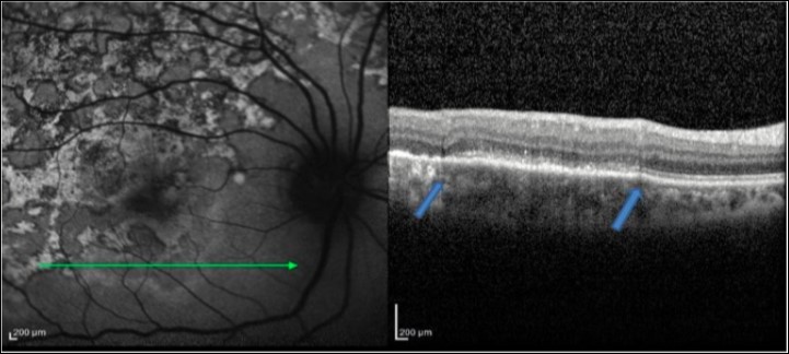 FAF (left) and corresponding eye-tracked SD-OCT image (right) of an example of transition area of anactive MSC (between red arrows) with no backscattering from the choroid .