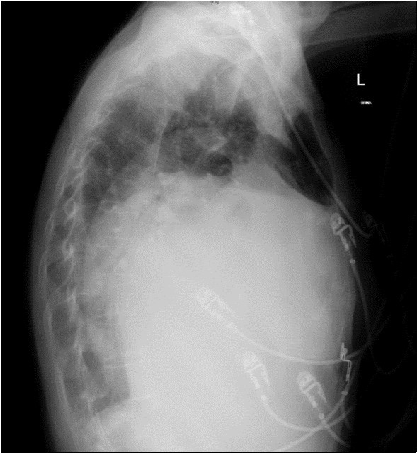 Chest X-ray Lateral view. Findings showing                  enlarged left atrium occupying large amounts of the thoracic cavity, both horizontally and vertically