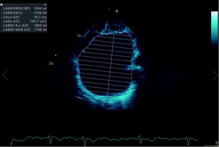 Transthoracic echocardiogram Apical 2C view. Left atrial size                estimation by Simpson’s biplane method from apical 2C view. Severely           enlarged left atrium (estimated 2108ml, 1548.5ml/m2)
