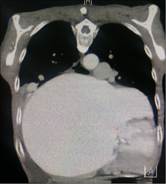 Computed tomography scan (CT) chest AP view, showing the extent of the left atrium filling the left and right hemithoraces.