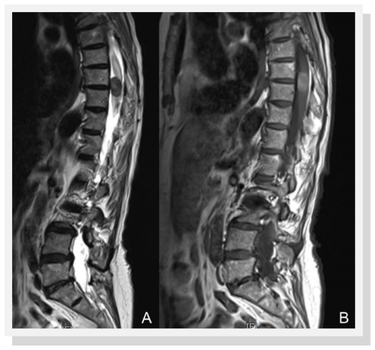 Spinal magnetic resonance imaging showing an intramedullary mass extending from T7-11 A) hypointense on T2 weighted sequences and B) slightly hyperintense on T1weighted imagines with mild and heterogeneous enhancement after the injection of gadolinium.