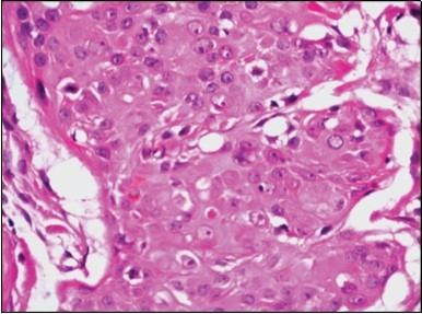 Duct like configurations and  atypical epithelial cells with prominent mitosis in eccrine porocarcinoma (22).