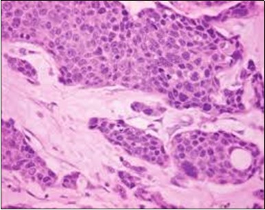 Eccrine porocarcinoma                     displaying cords and strands of atypical epithelial cells with glandular                arrangements (23).