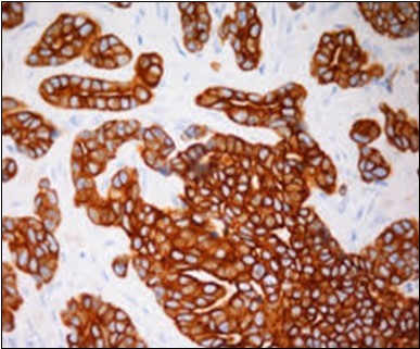 Immune reactivity to                cyto-keratin (CK7) in eccrine                          porocarcinoma(24).