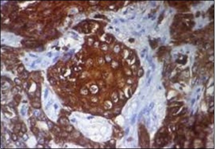 Immune reactivity to CK6 in            eccrine porocarcinoma(25).