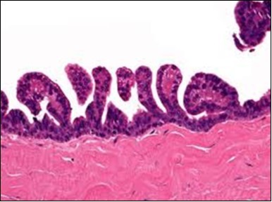 Epidermal projections lined with atypical and malignant epithelial cells in eccrine porocarcinoma (14).