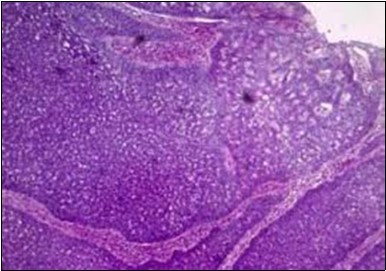 Cohesive accumulations with numerous ductular articulations                    of carcinoma cells in eccrine              porocarcinoma (15).