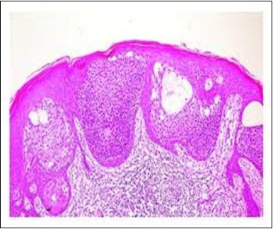 Epidermal continuity with   aggregates of atypical, solid  and cystic  epithelial cell nests in eccrine porocarcinoma (18).