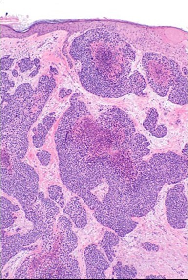 Branches and cords of                  malignant epithelial cells in eccrine porocarcinoma with a superficial,                 abutting  epithelium  and mitotic figures(21).
