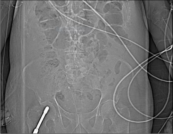 coronal plane CT scout image