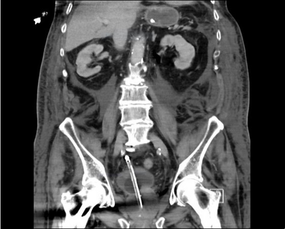 coronal plane CT image