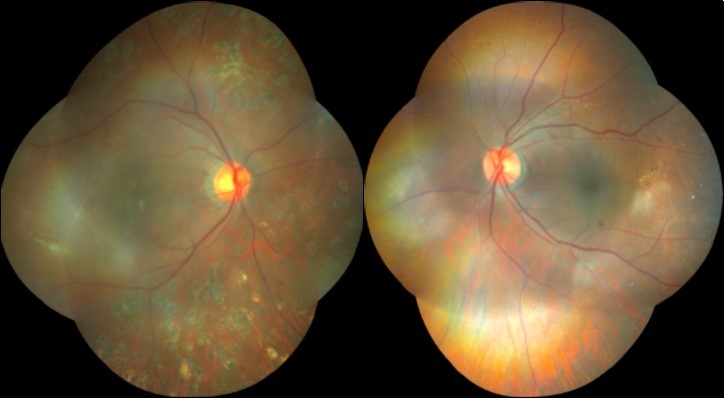 Case 1, Colored fundus photo, OU.  A) Right eye after resolution of vitreous hemorrhage: Laser scars seen outside the vascular arcades,                    fibroproliferative membrane in the inferotemporal macula (white arrow), exudates associated with retinal thickening in foveal area . B) Left eye: few dot hemorrhages seen in superior and temporal retina, blot heorrhage in the inferior perifoveal area, exudates seen in the temporal macula.
