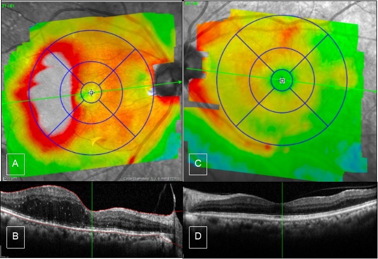 Case 1, OCT, OU.  A & B) Right eye showed edema of the temporal macula involving fovea, there is PVD from the macula but still attached to the optic nerve. C & D) Left eye has partial PVD, otherwise it is unremarkable.