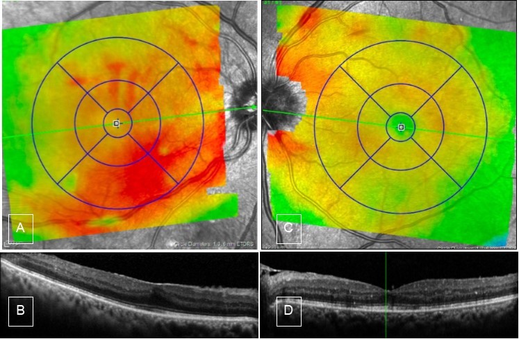 Case 2, OCT, OU.  A) Right eye shows thickening of inferior macula. B) high definition scan shows epiretinal membrane which causes straightening of the foveal contour. C & D) Left eye OCT is unremarkable.