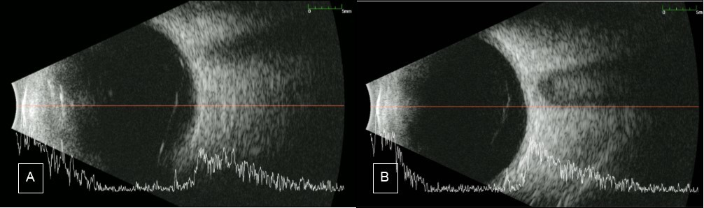 B-scan A) Case 1 Right eye: shows an almost complete PVD with remaining attachment to the optic nerve. B) Case 2 Right eye shows complete PVD