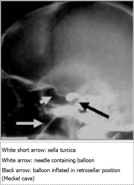 Procedure of gasserian balloon compression under fluoroscopic control