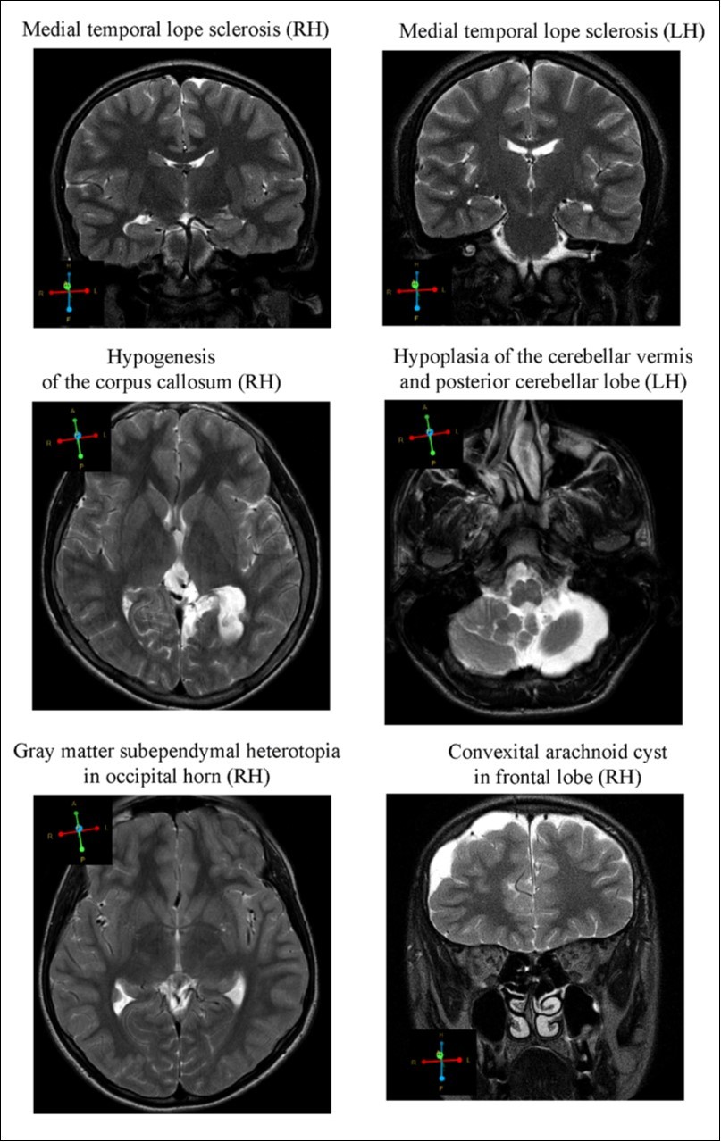 Representative images of the brain abnormalities observed in some children with the tendency of antisocial behavior (AST) by Magnetic Resonance Imaging (MRI). Coronal sections (4 mm thick) were acquired by T2 turpbo spin echo (TSE) multi vane (MV) sequence; Axial sections (6mm thick) - T2 TSE.