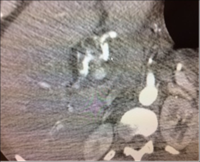 Case 4 –Hepatic Artery Aneurysm