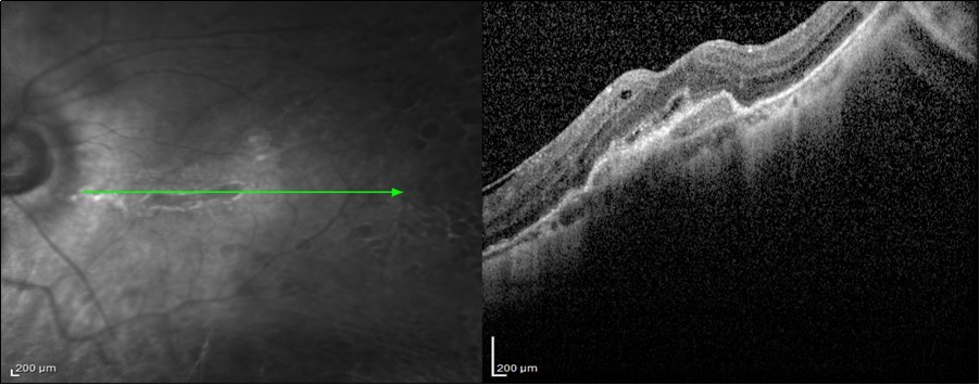 3 years Post-SOR SD-OCT image of a 44-year-old patient with BCVA 6/36 after                    anatomical repair of a macula-on GRT with encilrclage PPV + SOI with preoperative BCVA 6/6. We can notice the presence of SRNVM, IS/OS (ellipsoid zone) disruption, and RPE changes.