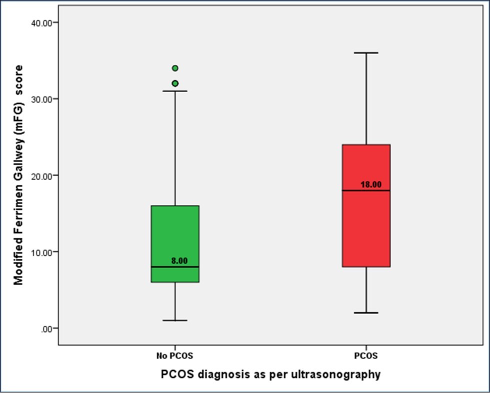 Differences in hirsutism as defined by modified FG score between subjects defined to have PCOS or otherwise as ultrasound diagnosis ((PCOS=87, Mean=16.95 + 9.57) (No PCOS=246, Mean=11.38 + 8.51), p< 0.001)