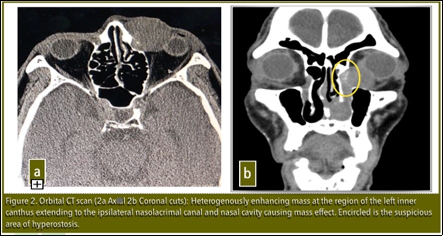 Orbital CT scan ( 2a Axial.  2b Coronal cuts): Heterogenously enhancing mass at the region of the left inner canthus extending to the ipsilateral nasolacrimal canal and nasal cavity causing mass effect. Encircled is the suspicious area of hyperostosis.