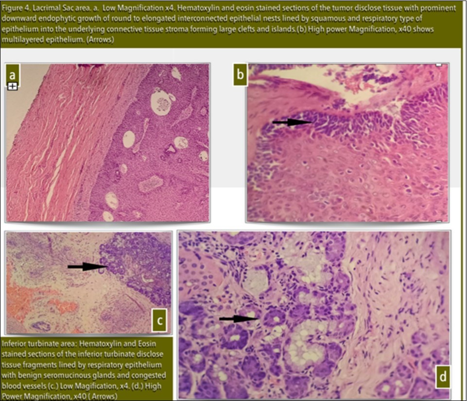 Lacrimal Sac area. a. Low Magnification x4. Haematoxylin and eosin stained sections of the tumor disclose tissue with prominent downward endophytic growth of round to elongated                      interconnected epithelial nests lined by squamous and respiratory type of epithelium into the                    underlying connective tissue stroma forming large clefts and islands. (b) High power Magnification, x40 shows multilayered epithelium. (Arrows)