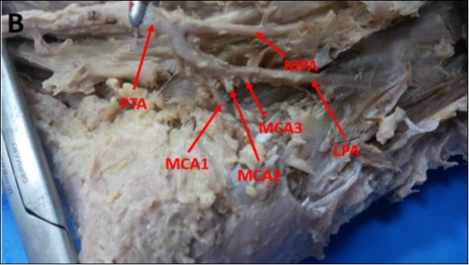 Photograph showing three medial calcaneal arteries (MCAs) branching from the lateral plantar artery (LPA) in a left foot. PTA: Posterior tibial artery, MPA: medial plantar artery.