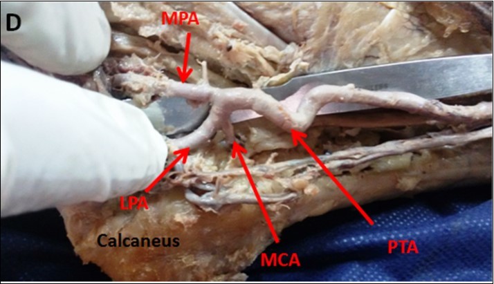 Photograph of the right ankle region (D) showing a single medial calcaneal artery (MCA) branching from the lateral plantar artery (LPA). PTA: Posterior tibial artery, MPA: medial plantar artery, MM: medial malleolus.